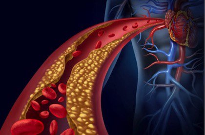 Nutrición y alimentación en dislipidemias